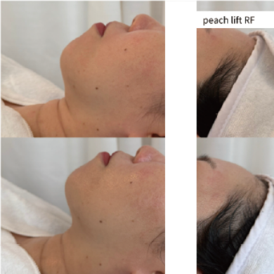 PEACH LIFT RF施術前後のフェイスライン比較