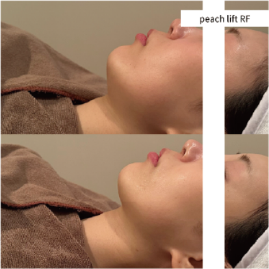 PEACH LIFT RF施術前後の横顔比較