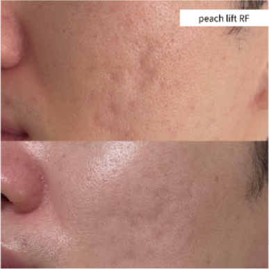 PEACH LIFT RF施術前後の口元比較