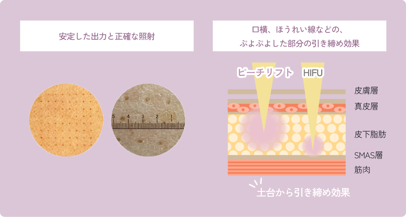 PEACH LIFT RFとHIFUの照射深度の違い