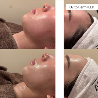 O2 to DermとLED施術前後