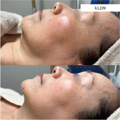 ULDM施術前後の頬とフェイスライン